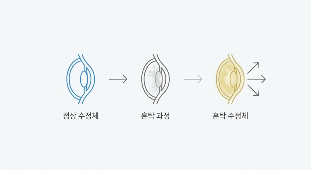 백내장이란? 수정체 혼탁이 시력을 빼앗는 과정