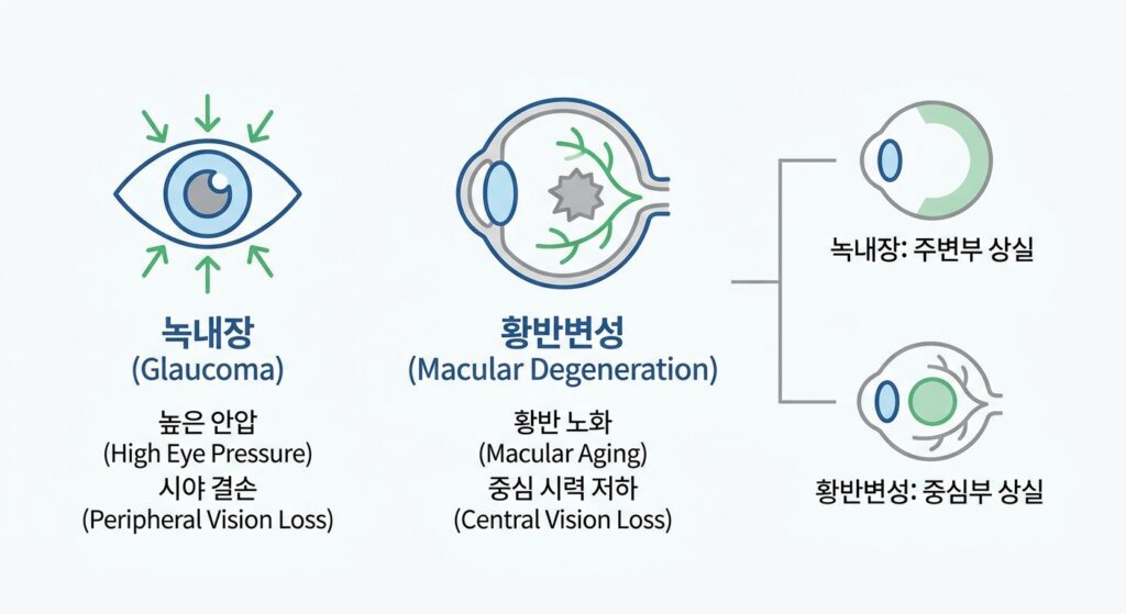 증상 없이 진행되는 눈 질환: 녹내장과 황반변성